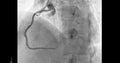 Cardiac catheterization on right coronary artery (RCA) .