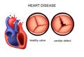 Cardiac defect. cardiology