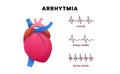 Cardiac disease arrhythmia with a heart and pulse ECG, showcasing normal heart rhythm, bradycardia or slow heart rate, and
