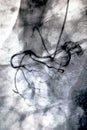Cardiac ventriculography. Catheterization