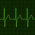 Cardiogram on digital device monitor. Electrocardiogram. Graphic representation of heart work . Health and medicine.