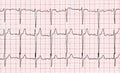 Cardiogram. Fragment of research result by CU Royalty Free Stock Photo