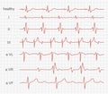 Cardiogram, heart red rhythm on monitor screen