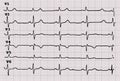 Cardiogram. Heartbeat. The graph on graph paper.