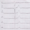 Cardiogram on paper. Shows heart rate.