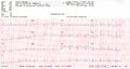 Cardiogram. waveform from an EKG showing borderline EKG test.