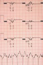 Cardiological tests results Royalty Free Stock Photo