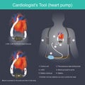 A Cardiologist`s Tool heart pump
