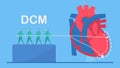 Cardiology vector illustration. This disease calls Dilated Cardiomyopathy. Ability of blood pumping is decreased. Left ventricle