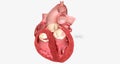 Cardiomyopathy is a disease of the heart muscle that causes the heart to have difficulty pumping blood to the body