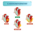 Cardiomyopathy medical disorders cross section diagram, vector illustration examples.