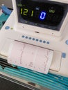 Electronic Fetal Monitor EFM recording the fetal heartbeat on the monitor and typing cardiogram