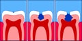 Caries Royalty Free Stock Photo