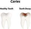 Caries Royalty Free Stock Photo