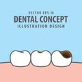 Caries and cavity teeth illustration vector on blue background. Royalty Free Stock Photo