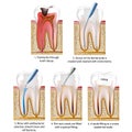 Caries destroyed tooth repaired with a crown or a tooth filling vector illustration process