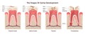 Caries development. Dental disease stages: enamel and dentin caries