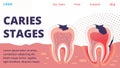 Caries Different Stages Treatment Vector Website