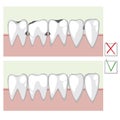 A Caries and healthy teeth before and after visiting an orthodontist or dentist, a vector stock illustration with infographics for
