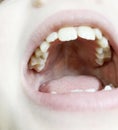 caries on milk upper chewing teeth