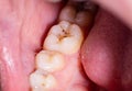 Caries in the mouth on the chewing teeth. Installation of high quality dental fillings. Dental treatment in modern