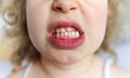 Caries and plaque on children's teeth.
