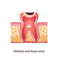 Caries Realistic Illustration Royalty Free Stock Photo