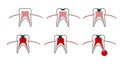 Caries stage, tooth decay scheme with caries, stomatological illustration with dental diseases, point by point schematic