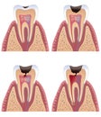 Caries stages Royalty Free Stock Photo