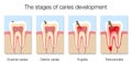 Caries Stages Development Tooth Decay Cross Sections