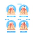 Caries Stages Infographics. Healthy Tooth, Enamel Caries, Dentin Caries, and Pulpitis Cross Section View, Medical Visual