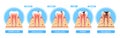 Caries Stages Infographics. Healthy Tooth, Enamel Caries, Dentin Caries, Pulpitis And Periodontitis Cross Section View