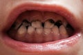 Caries teeth decay