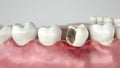 Caries in three stages - Stage 2 strong caries attack - 3D Rendering