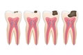 Caries tooth. Decay pulpit dental problem procedure root vector tooth medical pictures