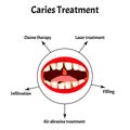 Caries treatment. Bad breath. Halitosis. The structure of the teeth and oral cavity with caries. Diseases of the teeth