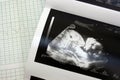 Cariograph and sonogram Royalty Free Stock Photo