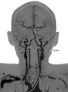 Carotid artery disease