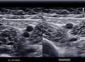 A carotid artery Doppler ultrasound is a diagnostic test used to check the arteries in the neck for diagnosis  any blockage in the Royalty Free Stock Photo