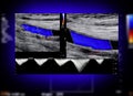 A carotid artery Doppler ultrasound is a diagnostic test used to check the arteries in the neck for diagnosis  any blockage in the Royalty Free Stock Photo