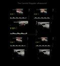 A carotid artery Doppler ultrasound is a diagnostic test used to check the arteries in the neck for diagnosis  any blockage in the Royalty Free Stock Photo