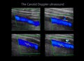 A carotid artery Doppler ultrasound is a diagnostic test used to check the arteries in the neck for diagnosis any blockage in the