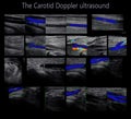 A carotid artery Doppler ultrasound is a diagnostic test used to check the arteries in the neck for diagnosis  any blockage in the Royalty Free Stock Photo