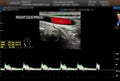 A carotid artery Doppler ultrasound is a diagnostic test used to check the arteries in the neck for diagnosis  any blockage in the Royalty Free Stock Photo