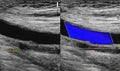 A carotid artery Doppler ultrasound is a diagnostic test used to check the arteries in the neck for diagnosis any blockage in the