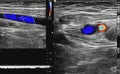 A carotid artery Doppler ultrasound is a diagnostic test used to check the arteries in the neck for diagnosis any blockage in the