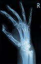 Carpal bones Human X Ray