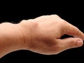 Carpal ganglion cyst