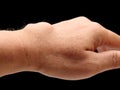 Carpal ganglion cyst