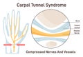 Carpal tunnel syndrome. Compressed median nerve. Carpal tunnel anatomy Royalty Free Stock Photo